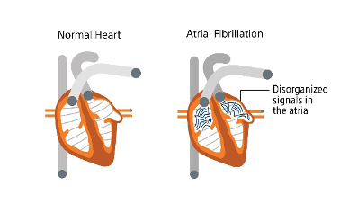 A heart illustration showing a normal heart and heart in Afib