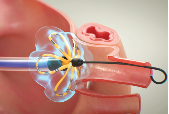 An illustration showing how the FARAPULSE procedure delivers electrical pulses inside the heart.