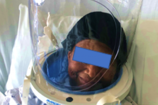 Patient wearing a bubble helmet